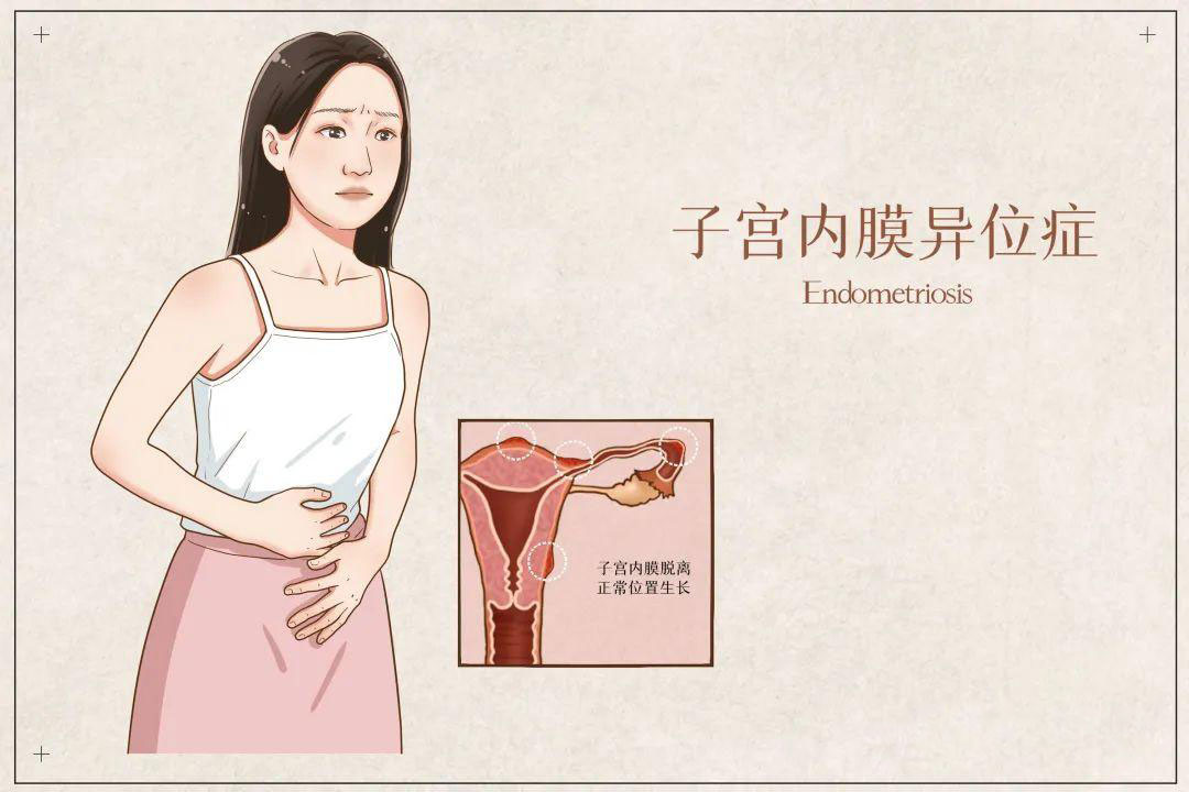 子宫内膜异位症做试管婴儿移植鲜胚后可以吃枇杷吗？会不会影响着床？