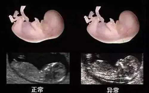 NT报告单显示三个亮点就是告诉你胎儿的性别